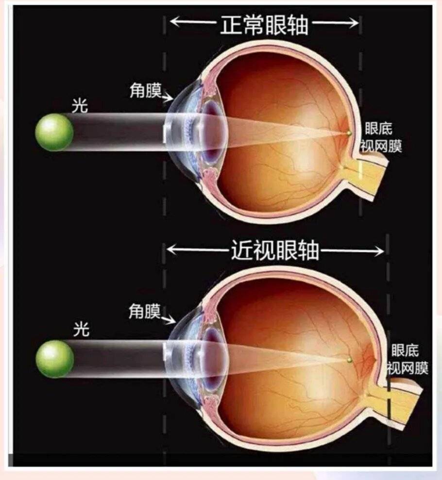 44岁货运司机在太原爱尔“一站式摘掉”近视与白内障， 术后送上单字锦旗：“赞”！